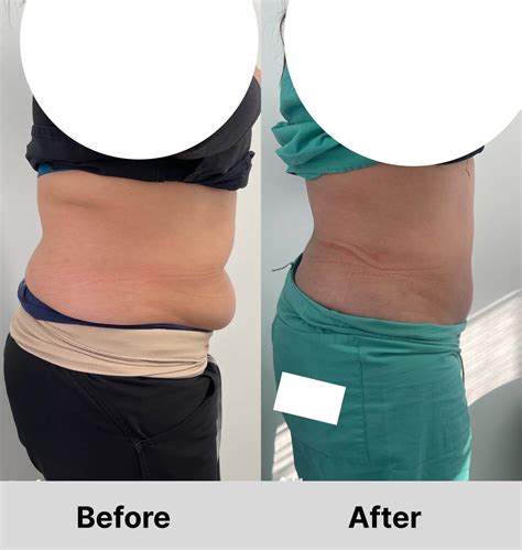 Emsculpt Neo Transformation at Rated R Esthetics in San Jose.